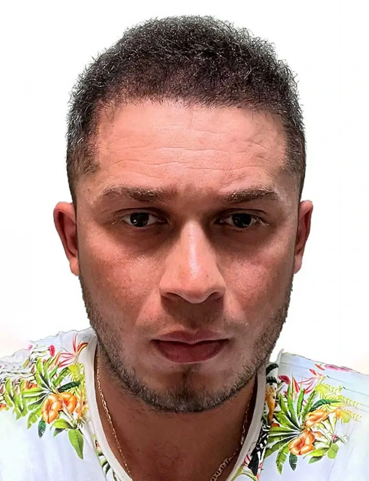 hair-transplant-after-31989.webp