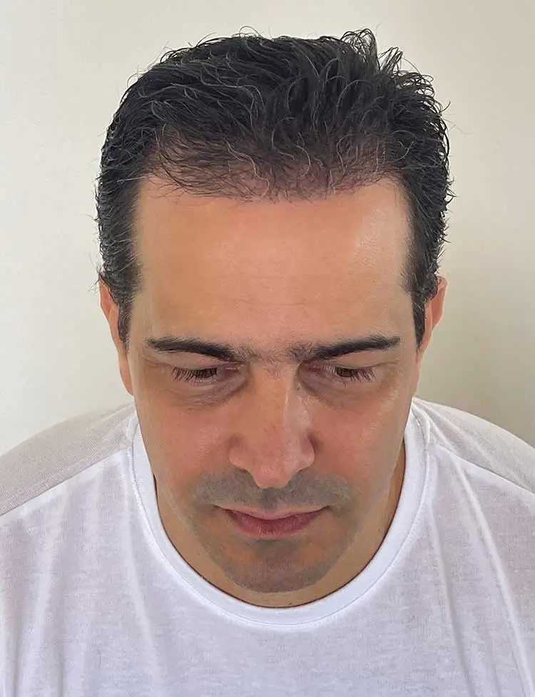 hair-transplant-after-38646.webp