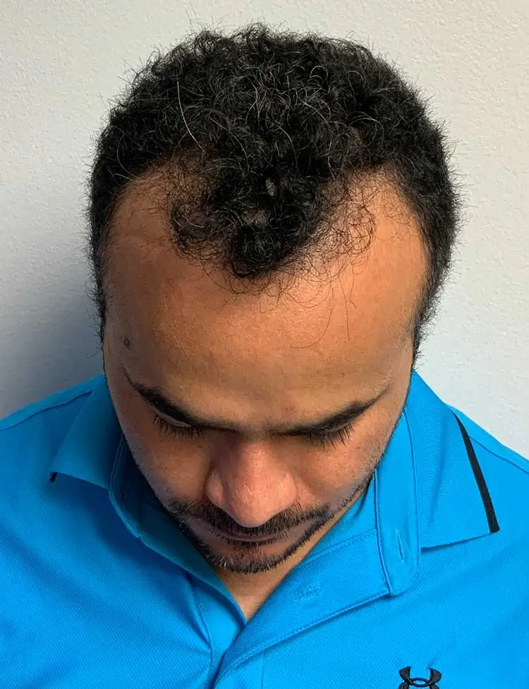 hair-transplant-before-31519.webp