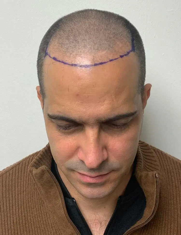 hair-transplant-before-38646.webp