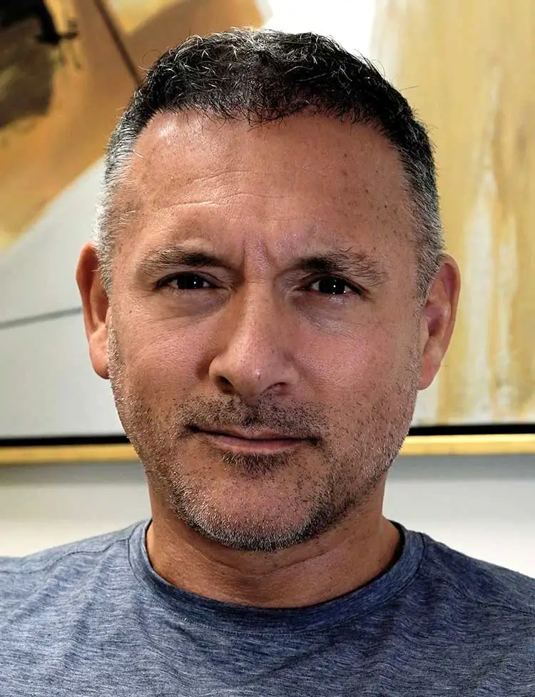 hair-transplant-miami-after-44428.webp