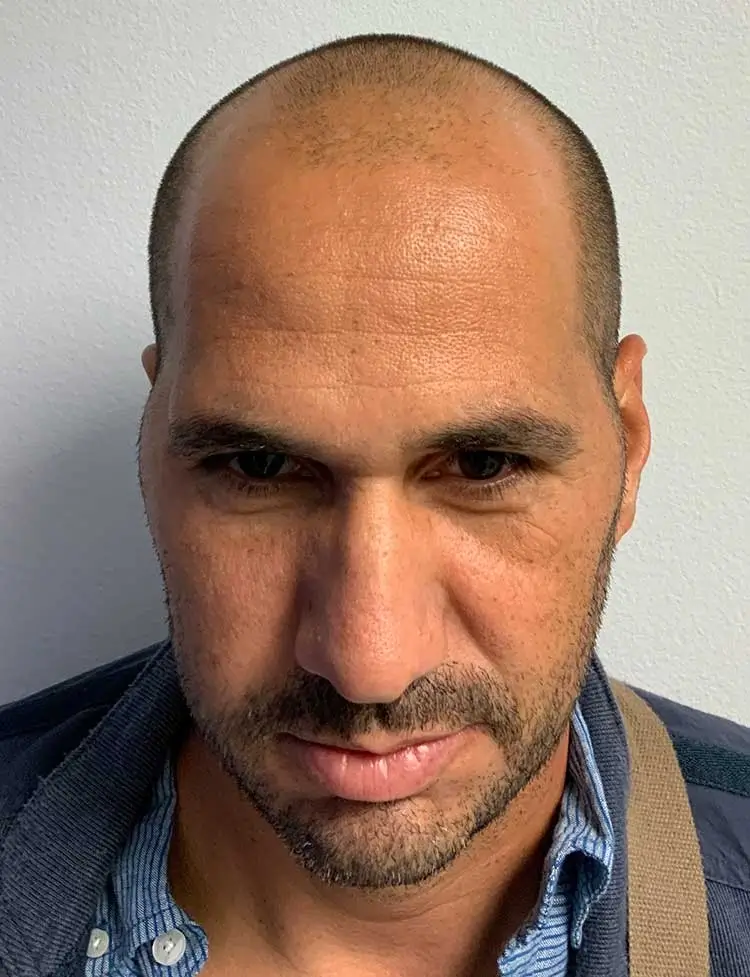 hair-transplant-miami-before-26389.webp